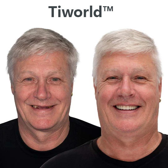 👵Health America Subsidized Product | Tiworld™ AdaptableFit Functional Dentures – Made in the USA & FDA-Certified